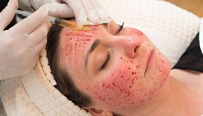 CDC urges people to ensure these things before getting vampire facial. — Impact Medical Cosmetics