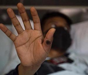 Pakistan issues alert after surge in monkeypox cases globally