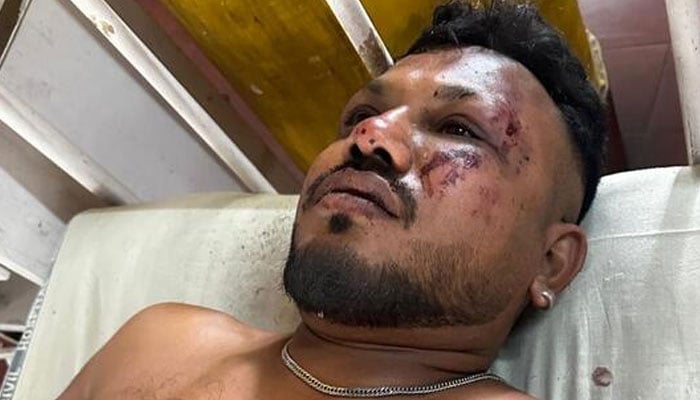 British national Vishwash Kumar Ramesh, the sole survivor of Air India plane crash, receives treatment at hospital in Ahmedabad on June 12, 2025. — Hindustan Times