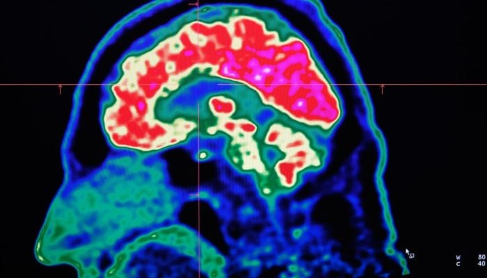 A picture of a human brain taken by a positron emission tomography scanner, also called PET scan, is seen on a screen on January 9, 2019, at the Regional and University Hospital Center of Brest (CRHU - Centre Hospitalier Regional et Universitaire de Brest), western France. — AFP