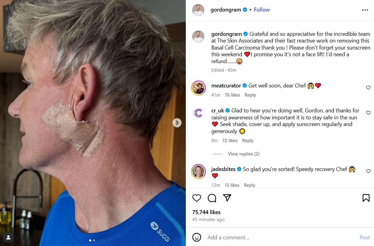Gordon Ramsay reveals skin cancer diagnosis