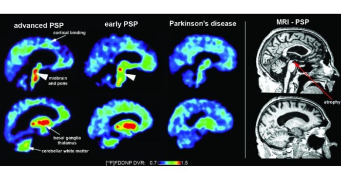 Civil rights leader Jesse Jackson hospitalized for observation of rare neurological disorder