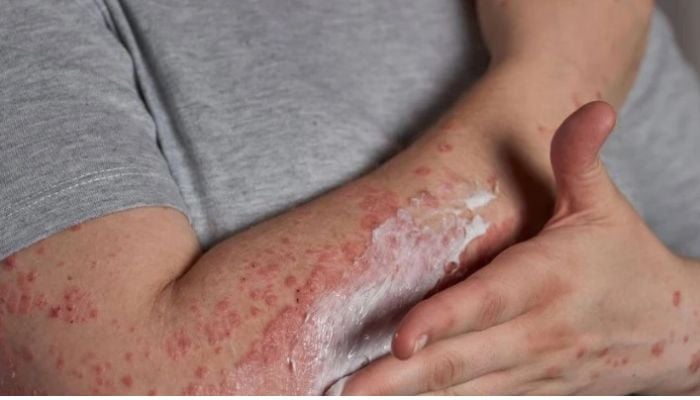 UK detects new hybrid Mpox strain in traveller from Asia