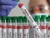 UK detects new hybrid Mpox strain in traveller from Asia