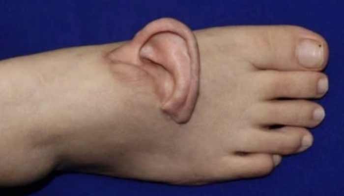 Image shows foot of the victim woman whose ear attached to foot to keep it tissues alive. — Mirror