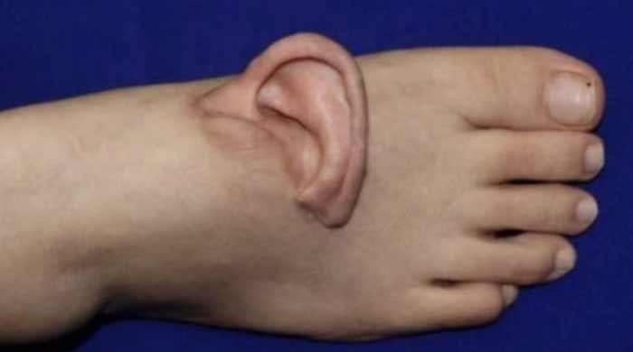 Chinese surgeons attach woman's torn ear to foot after accident