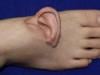 Chinese surgeons attach woman's torn ear to foot after accident