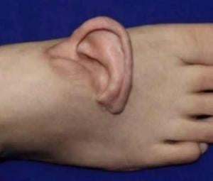 Chinese surgeons attach woman's torn ear to foot after accident