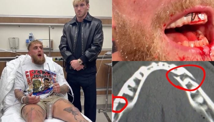 Jake Paul suffers broken jaw in Knockout loss to Anthony Joshua