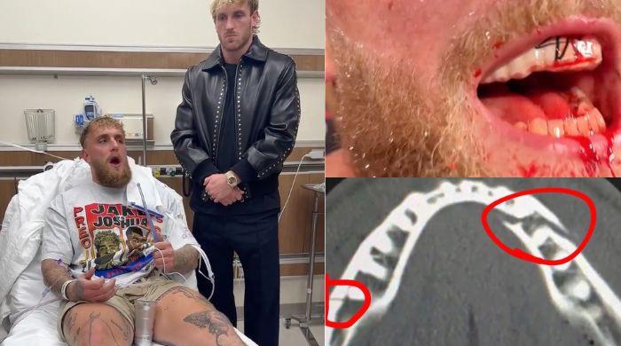 Jake Paul suffers broken jaw in Knockout loss to Anthony Joshua