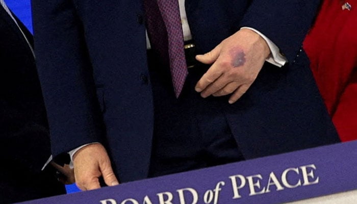 US President Donald Trumps bruised hand, as he attends a charter announcement for his Board of Peace initiative aimed at resolving global conflicts, alongside the 56th annual World Economic Forum (WEF), in Davos, Switzerland, January 22, 2026. — Reuters