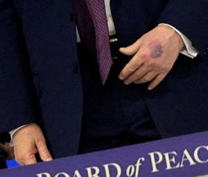 Trump's hands seen bruised in new photos