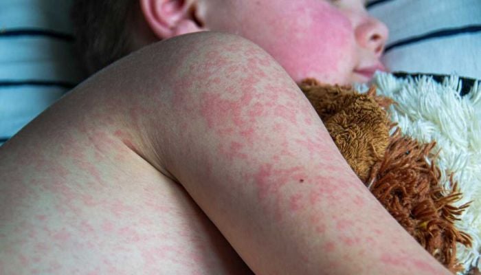 Measles outbreak escalates: How to keep your children safe?