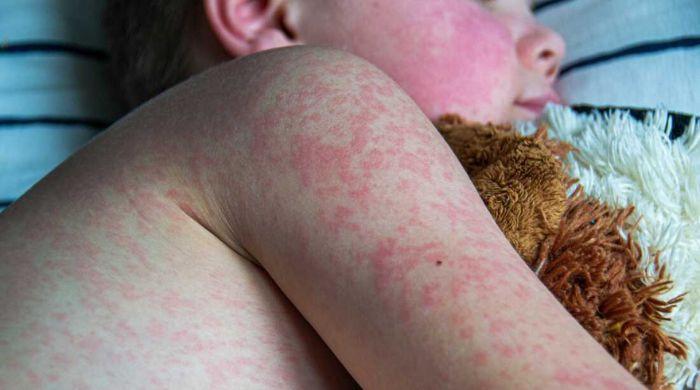 Measles outbreak escalates: How to keep your children safe?