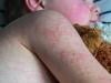 Measles outbreak escalates: How to keep your children safe?
