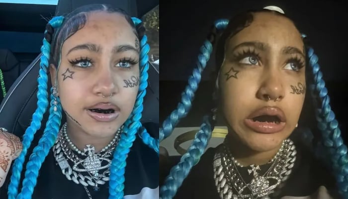 North West reveals bruises after taking off controversial finger piercings