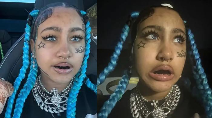 North West reveals bruises after taking off controversial finger piercings