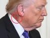 Trump's neck rash sparks fresh health questions