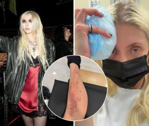 Taylor Momsen hospitalised week after getting bit by spider on AC/DC tour
