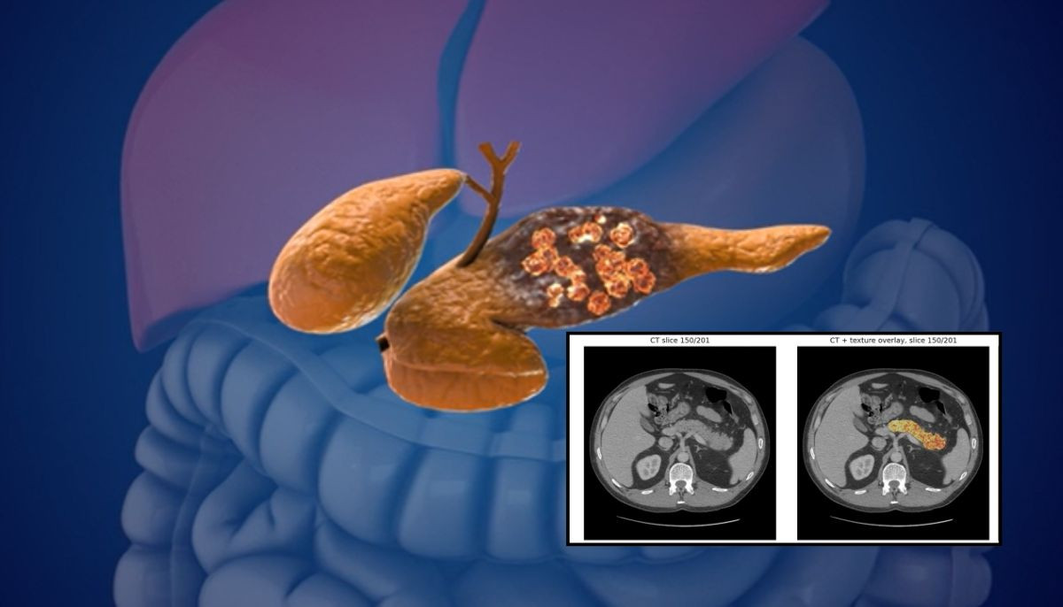 AI detects pancreatic cancer 3 years before diagnosis: Study reveals breakthrough results