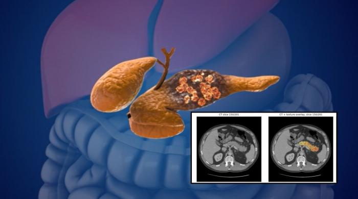 AI detects pancreatic cancer 3 years before diagnosis: Study reveals breakthrough results