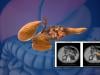 AI detects pancreatic cancer 3 years before diagnosis: Study reveals breakthrough results