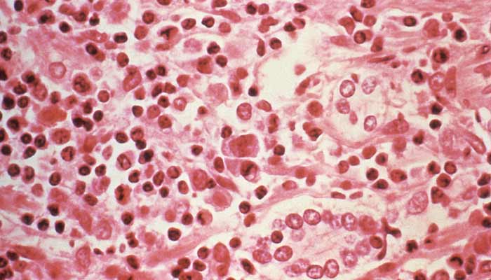 A micrographic study of liver tissue seen from a Hantavirus pulmonary syndrome (HPS) patient seen in this undated photo obtained by Reuters, July 6, 2017.— Reuters/File