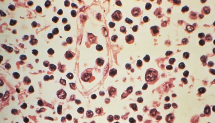 Some of the cytoarchitectural features in a lymph node specimen extracted from a patient suspected of a Hantavirus illness are seen in this handout photo obtained by Reuters, July 6, 2017. — Reuters