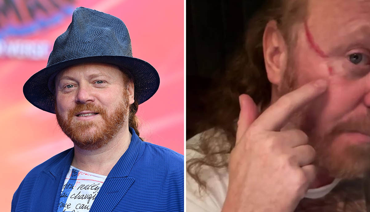 Leigh Francis suffers shocking festival injury