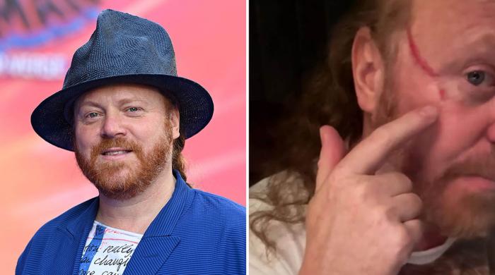 Leigh Francis suffers shocking festival injury