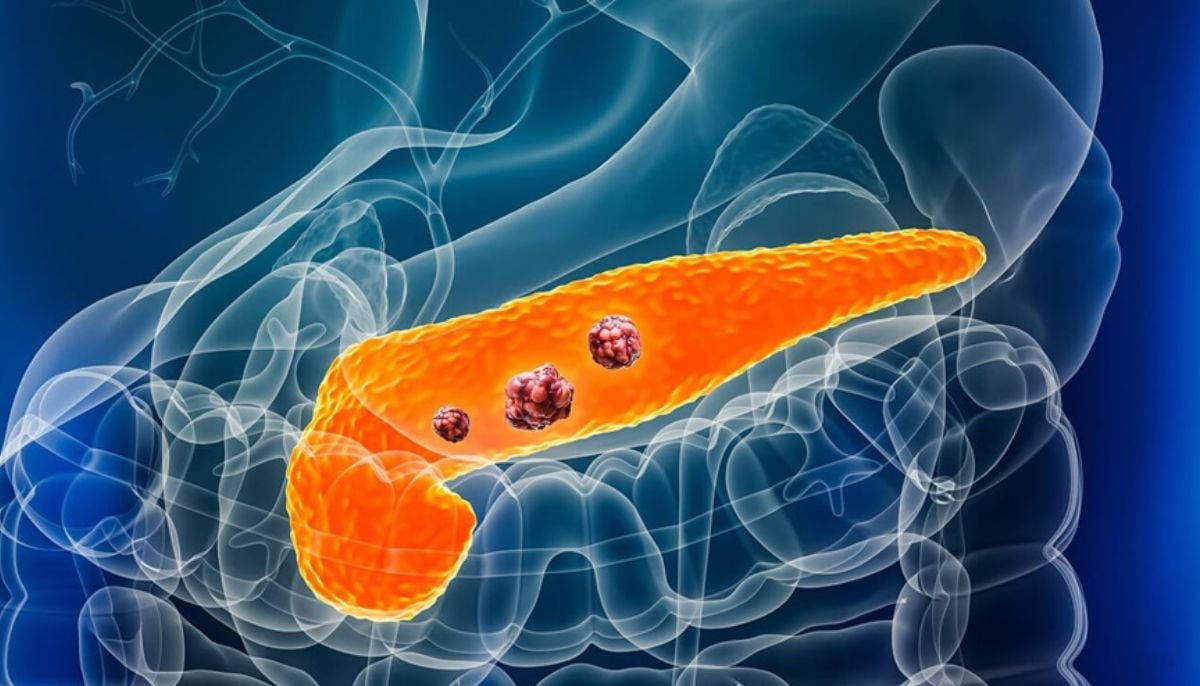 Scientists find first effective treatment for pancreatic cancer in decades