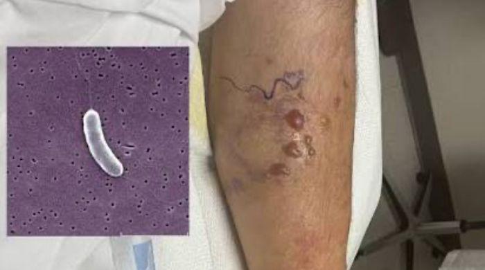 What is Vibrio Vulnificus? Flesh eating bacteria spreading in Gulf waters that has killed 5