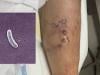 What is Vibrio Vulnificus? Flesh eating bacteria spreading in Gulf waters that has killed 5