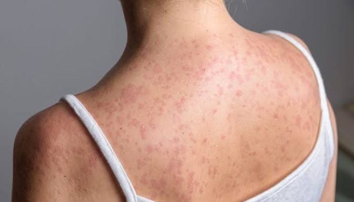 Who are two people who died of Measles in Pennsylvania? What we know