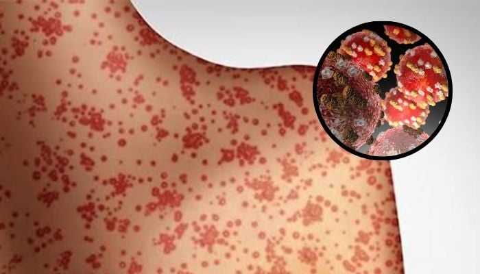 Which US states are at highest risk of measles in 2026? Full details about active outbreak