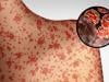 Which US states are at highest risk of measles in 2026? Full details about active outbreak