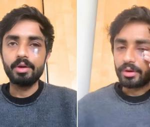 Pakistani student suffers facial fractures in racist attack in Glasgow