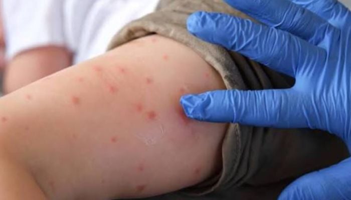 Pennsylvania reports most measles death in US over 30 years: Here’s update
