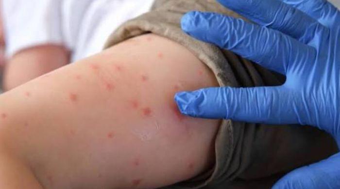 Pennsylvania reports most measles death in US over 30 years: Here's update