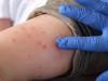 Pennsylvania reports most measles death in US over 30 years: Here's update