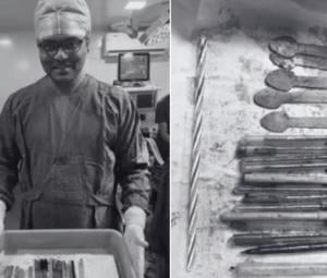 Doctors remove 14 pens, spoons, candle from woman's stomach in India